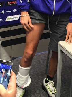 Valentino Rossi toont zijn gebroken been